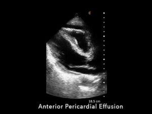 Anterior Pericardial Effusion