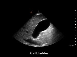 Gallbladder