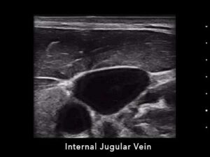 Internal Jugular Vein