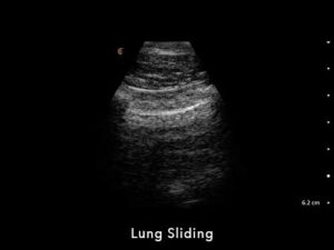 Lung Sliding