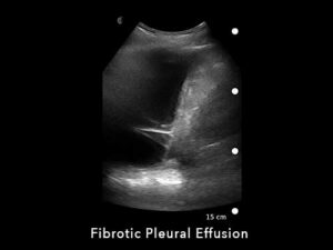 Fibrotic Pleural Effusion