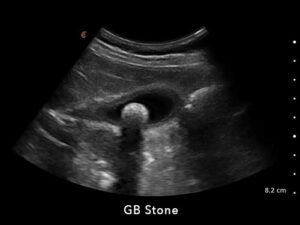 GB Stone