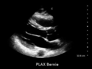 PLAX Bernie