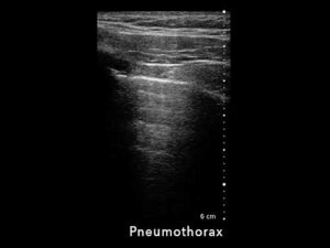 Pneumothorax