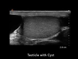 Testicle with cyst